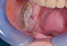 Osteonecrosi delle ossa mascellari farmaco relata: conoscerla per prevenirla osteonecrosi mascellari