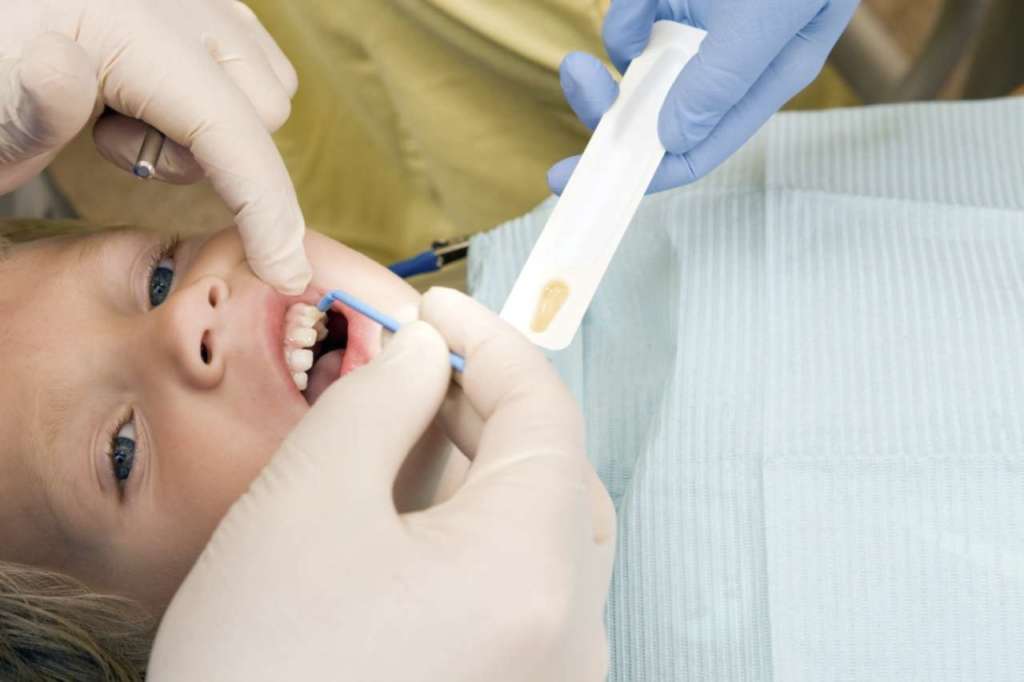 fluoro topico e sigillanti