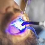 La polimerizzazione prolungata migliora durata e qualità dei restauri polimerizzazione prolungata