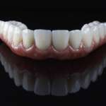 Equilibrio occlusale e attività muscolare nei pazienti con protesi mandibolare equilibrio occlusale e attività muscolare