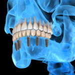 Chirurgia guidata: diagnosi e nuovi protocolli digitali Chirurgia guidata