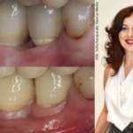 Prevenire la perimplantite: effetti a lungo termine di un sistema implantare a due componenti