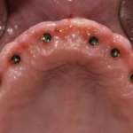 Carico immediato in mascellare edentulo con impianti tissue-level senza l’uso di Multi Unit Abutment. Case report riabilitazione full-arch