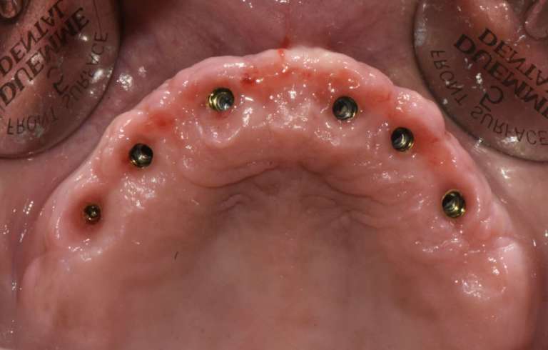 Carico immediato in mascellare edentulo con impianti tissue-level senza l’uso di Multi Unit Abutment. Case report