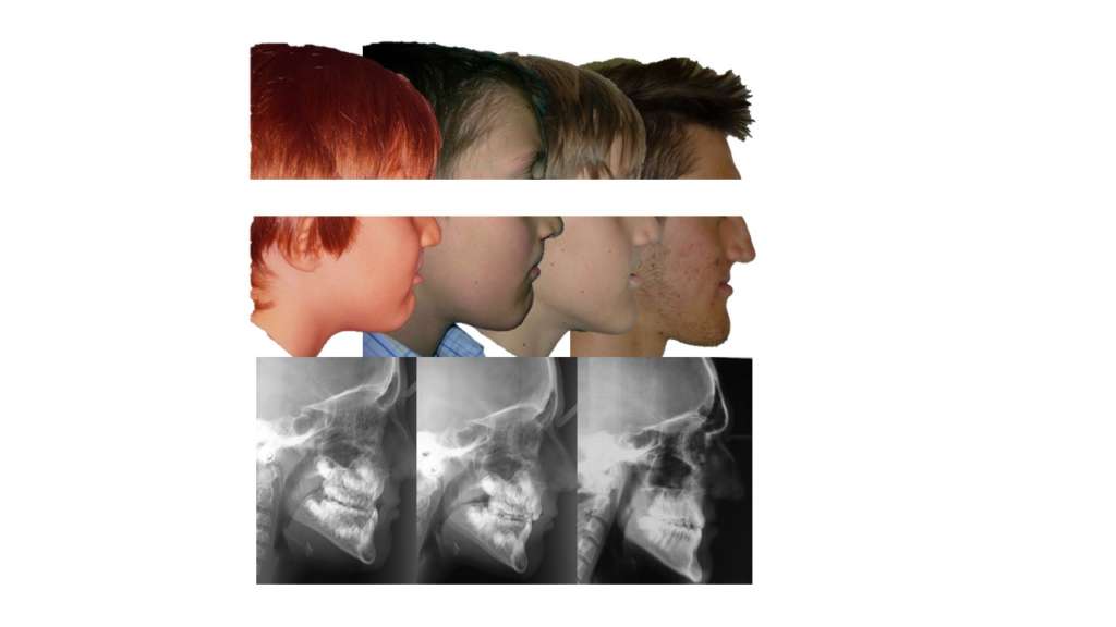 Trattamento III Classi Labiopalatoschisi