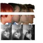 Il trattamento delle III Classi nei pazienti con labiopalatoschisi Trattamento III Classi Labiopalatoschisi