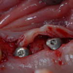 Rialzo di seno per via transcrestale con tecnica SCA tecnica SCA