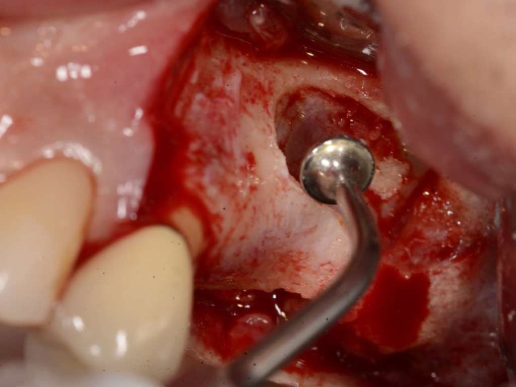 piezoelettrico seno mascellare