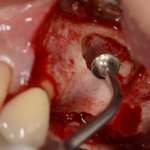 Il piezoelettrico nel rialzo del seno mascellare piezoelettrico seno mascellare