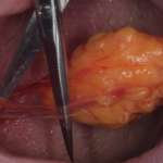 Lipoma intraorale: caso clinico di exeresi