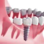 Osteointegrazione e diagnostica ultrasonografica transalveolare osteointegrazione
