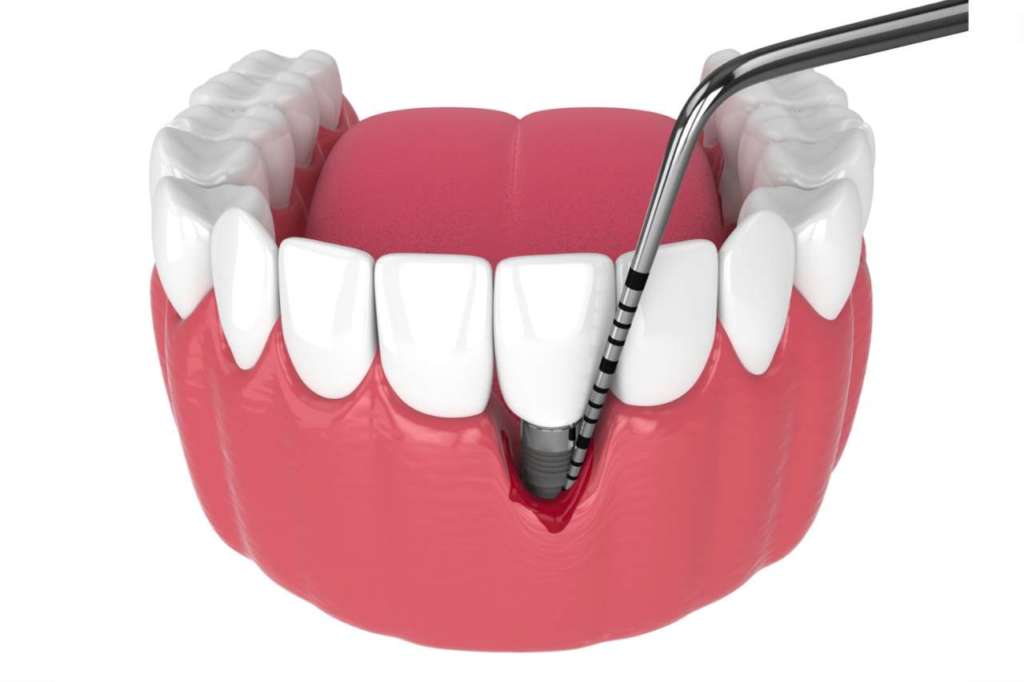 trattamento parodontale non chirurgico