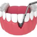 Trattamento parodontale non chirurgico, due metodi a confronto trattamento parodontale non chirurgico