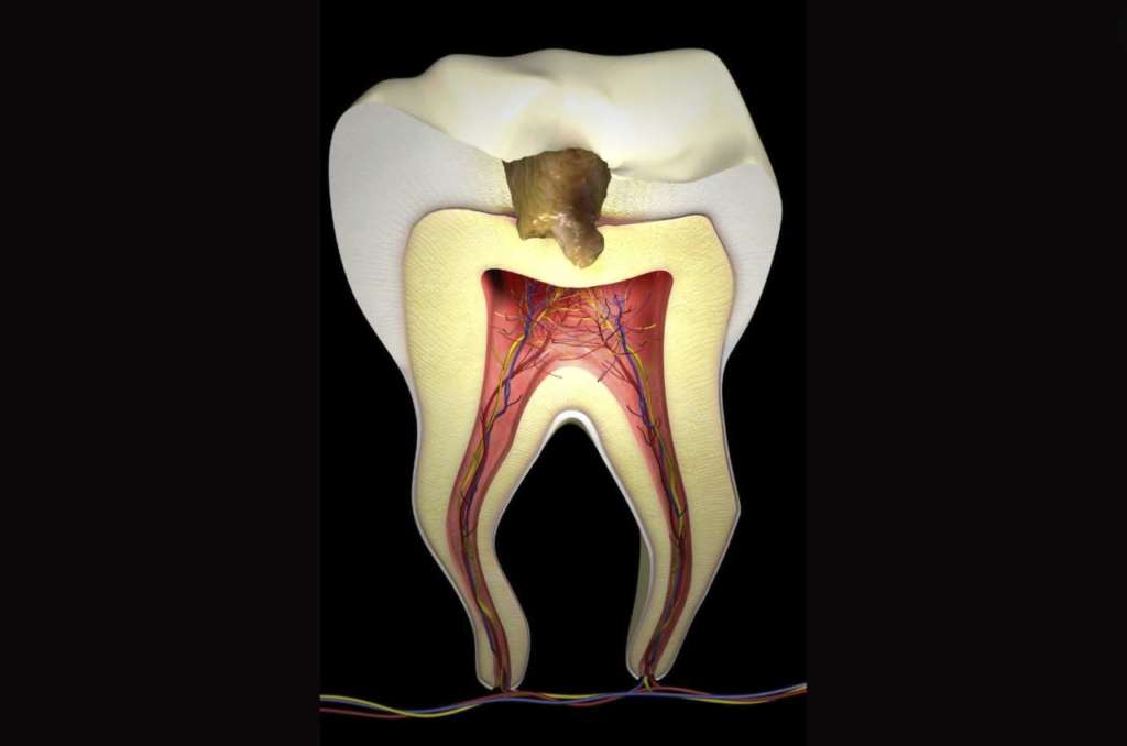 incappucciamento diretto