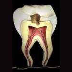 Incappucciamento diretto della polpa, gli esiti a 4 anni di distanza incappucciamento diretto