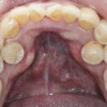 I denti sovrannumerari analizzati con la CBCT Denti sovrannumerari