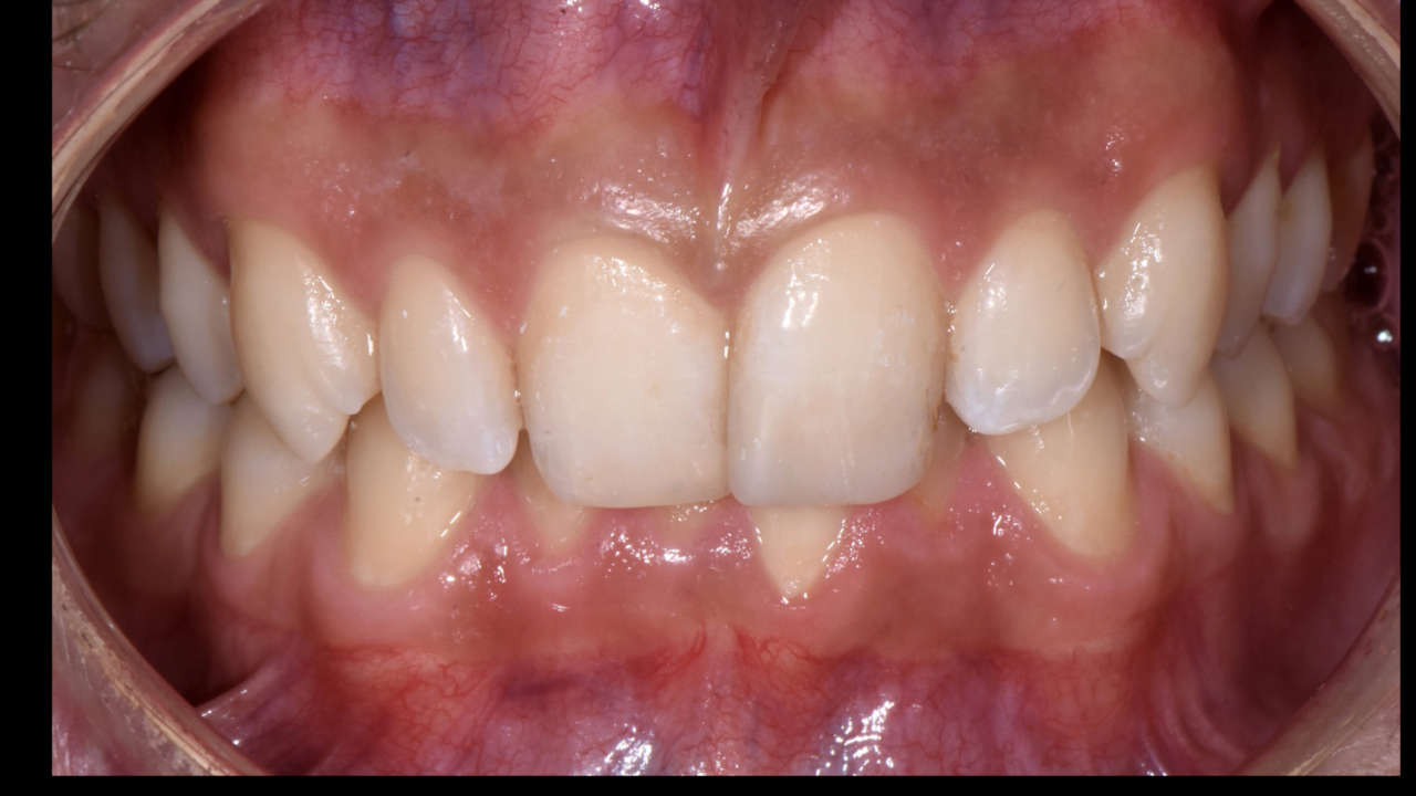 compositi clustershade