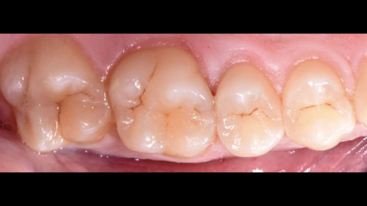 compositi clustershade