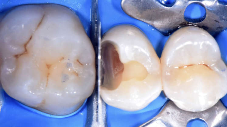 compositi clustershade