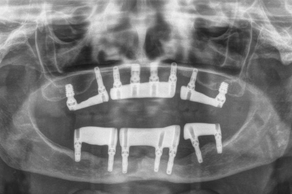 Atrofia ossea mascellare