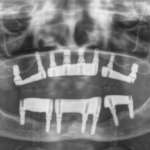 Grave atrofia ossea di mascellare superiore e mandibola: riabilitazione con tecniche minimamente invasive Atrofia ossea mascellare