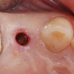 Preservazione dei volumi osseo-connettivali in alveoli post-estrattivi, inserimento implantare differito e valutazione istologica