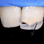 Efficacia dei nuovi compositi clustershade nei restauri posteriori e anteriori