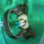 Fattori di rischio trattamento endodontico: comprenderli è cruciale per la sopravvivenza del dente Fattori di rischio trattamento endodontico