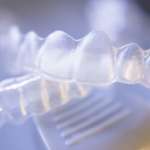 Trattamento ortodontico e carie: i risultati di una ricerca sugli adolescenti trattamento ortodontico e carie