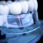 CBCT e artefatti causati dagli impianti in titanio e in zirconia CBCT e artefatti