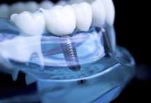 CBCT e artefatti causati dagli impianti in titanio e in zirconia CBCT e artefatti