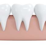 Apice aperto, uno studio fa il punto sui trattamenti possibili apice aperto