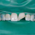 Resmile Template mode, un approccio digitale e calibrato in odontoiatria estetica Resmile template mode