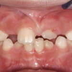 Odontoiatria 4.0: il digitale nella cura del sorriso dei più piccoli Odontoiatria 4.0 paziente pediatrico