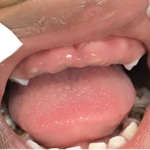 Gestione interdisciplinare dei traumi orofacciali da maltrattamento nella prima infanzia: originale sistema di allerta Traumi orofacciali prima infanzia