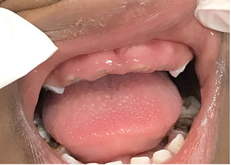 Traumi orofacciali prima infanzia