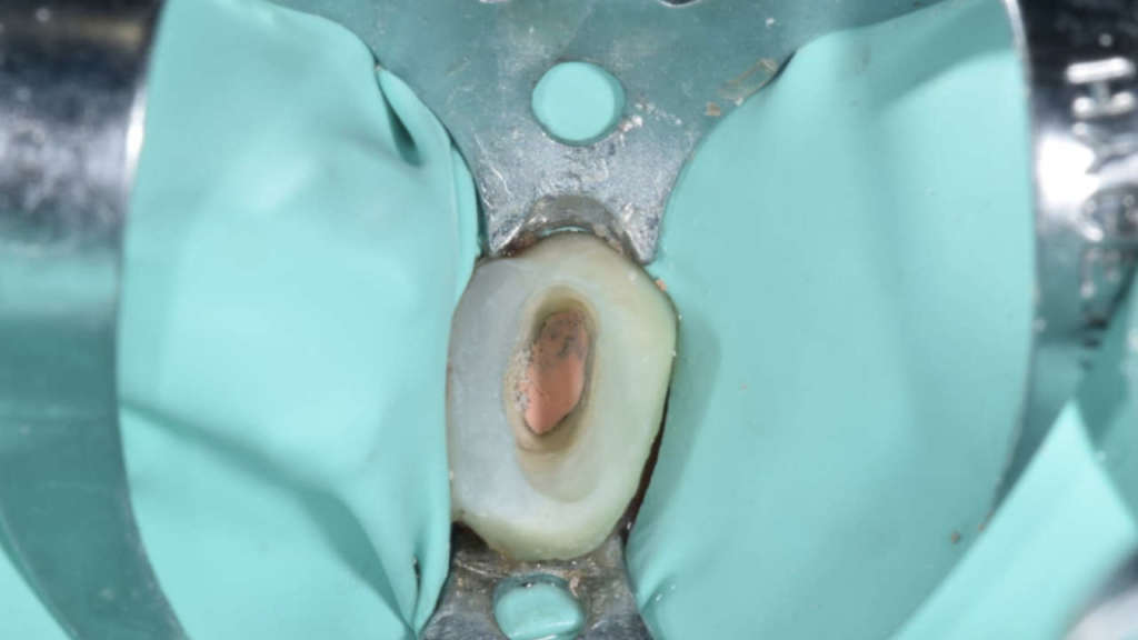 Approccio endo-perio-restaurativo