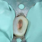 Approccio endo-perio-restaurativo per il recupero di 3.5 e 3.6 severamente compromessi in paziente giovane Approccio endo-perio-restaurativo