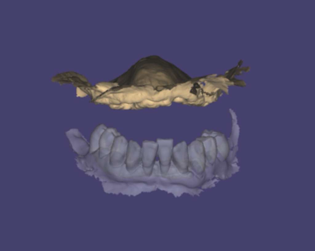 Protesi full digitale