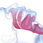 OSAS, la sindrome delle apnee ostruttive del sonno nell’adulto e nel bambino OSAS adulto e bambino