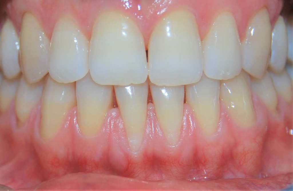 Tecniche chirurgiche recessione gengivale