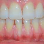 Principi biologici, applicazioni cliniche e tecniche chirurgiche nella copertura di una recessione gengivale di Classe 3 in zona estetica Tecniche chirurgiche recessione gengivale