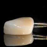 Riabilitazione in area estetica con impianto a diametro ridotto e rigenerazione ossea guidata dopo frattura dentale apicale impianto diametro ridotto