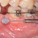 Miniviti ortodontiche (TADs): un alleato in più nell’ortodonzia moderna Miniviti ortodontiche