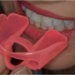 Update nella gestione del bite nei disordini temporo mandibolari bite anello linguale