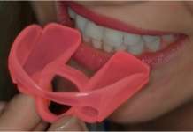 Update nella gestione del bite nei disordini temporo mandibolari bite anello linguale