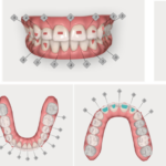 Il ruolo dell’allineamento dentale nell’approccio mini-invasivo alla riabilitazione estetica