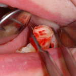 Chirurgia orale: il piezoelettrico nell’estrazione di un terzo molare piezoelettrico estrazione terzo molare