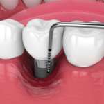 Parodontite, uno studio svela il ruolo di nuove varianti genetiche Parodontite