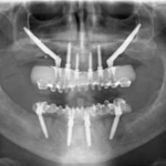 Tecnica Hybrid Zygoma per la riabilitazione di un mascellare atrofico